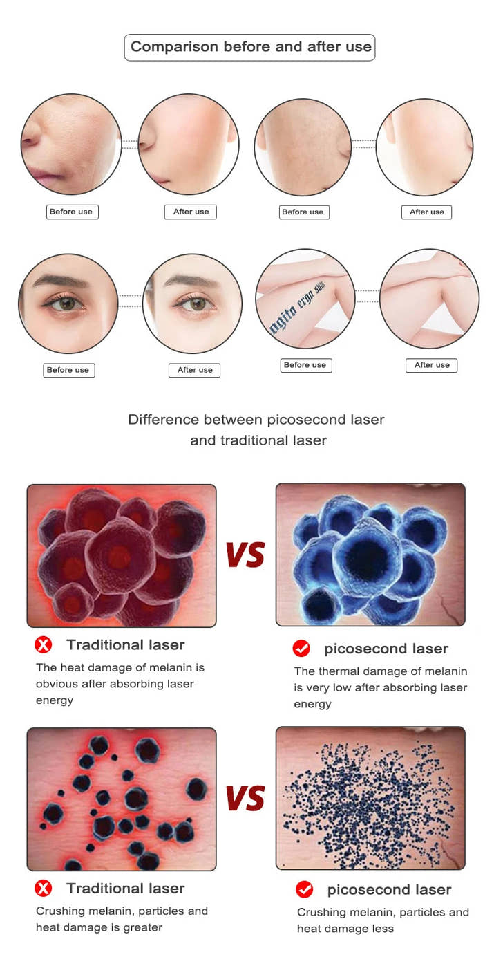 Picosecond Laser Pointer for Mole Removal  Dark Spot Removal Pen Tattoo Acne Skin Pigment Portable Removal Machine Beauty Device